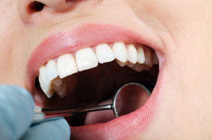 Dental Sealants in Chicago: Protecting Children and Adults from Tooth Decay