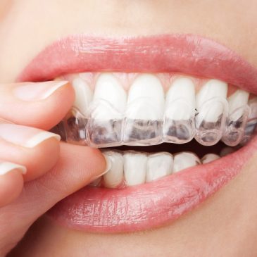 Have a Great Orthodontic Journey in Summit Argo, IL with These Tips!