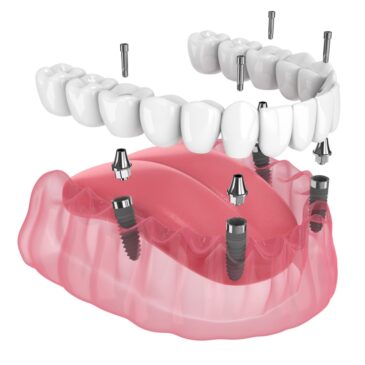 Everything You Need To Know About All-On-4 Dental Implants